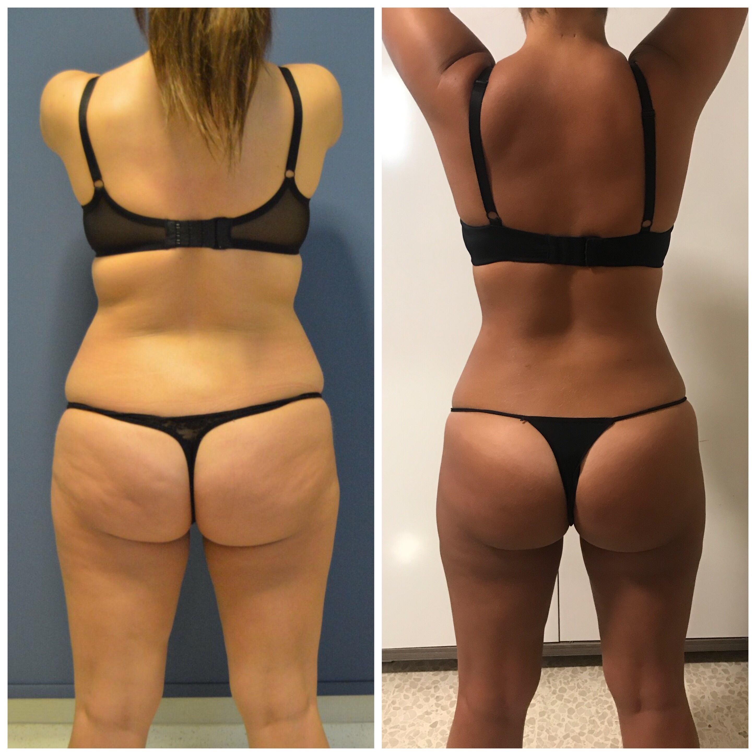 Adelgazar corriendo antes y despues lipo